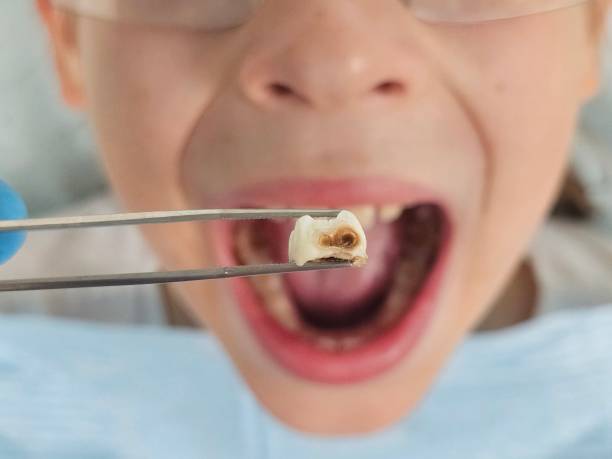Best Emergency Dentist for Lost Fillings or Crowns in West Richland, WA